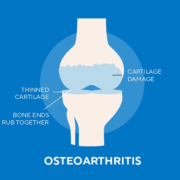 aleve-article-arthritispain-callout-1