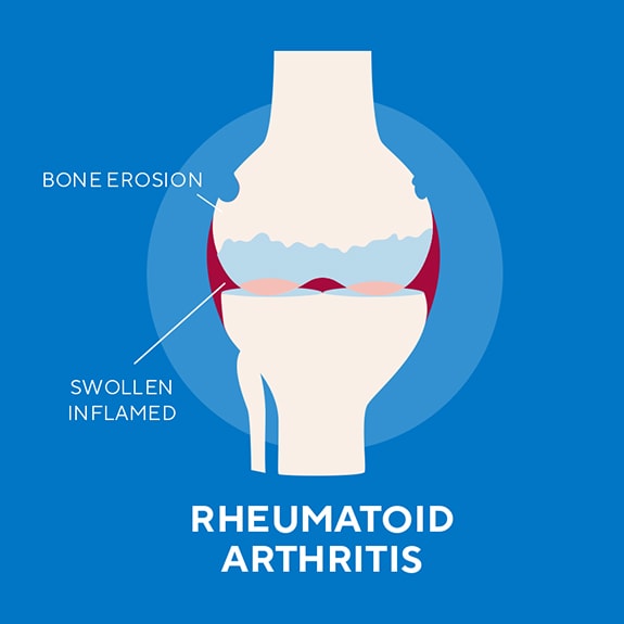 aleve-article-arthritispain-callout-2